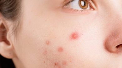 علاج حب الشباب