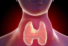تضخم الغدة الدرقية